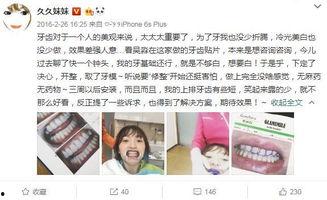 明星网红牙贴面